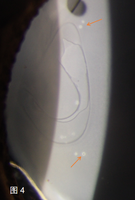 白内障术后人工晶体混浊1例 (4).png