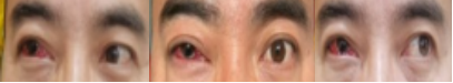 单眼直肌超常量治疗大角度知觉性外斜视1例  (5).png